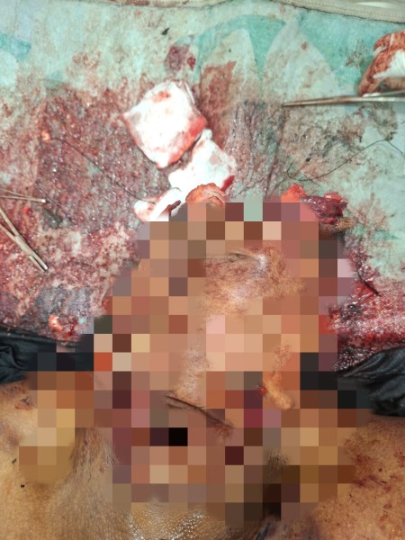 Karyawan PKS Tanjung Medan Meregang Nyawa Pihak Perusahaan Terkesan Menutupi